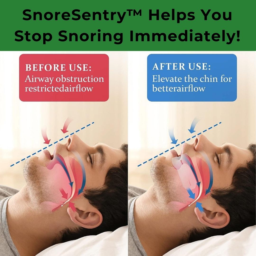 SnoreSentry™️ Anti Snoring mouthpiece by Barlev's